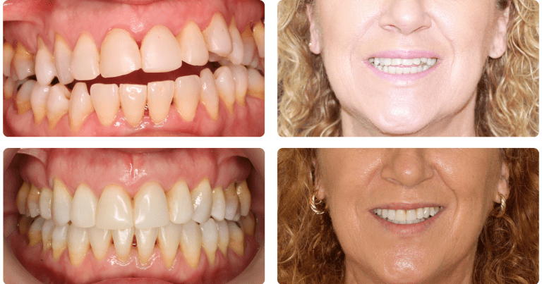 Caso tratamiento dental Clínica dental Zafra